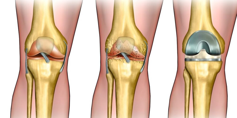 Knee articulation arthrosis